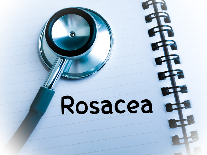 home remedies for rosacea