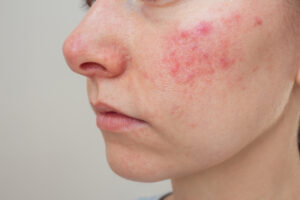 Home Remedies for Rosacea