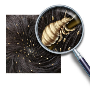 home remedies for lice